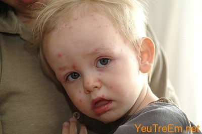 Child with chicken pox, Image: 43343590, License: Royalty-free, Restrictions: , Model Release: yes, Credit line: Profimedia, imageBROKER